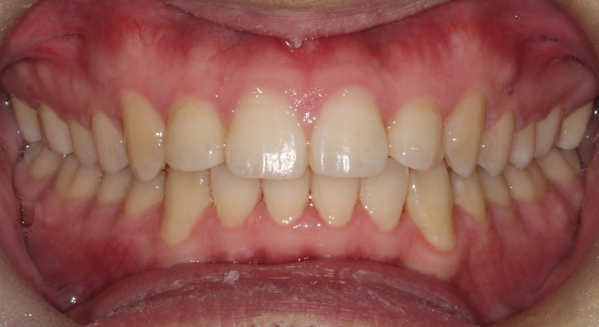 Case 4 - Front View - After