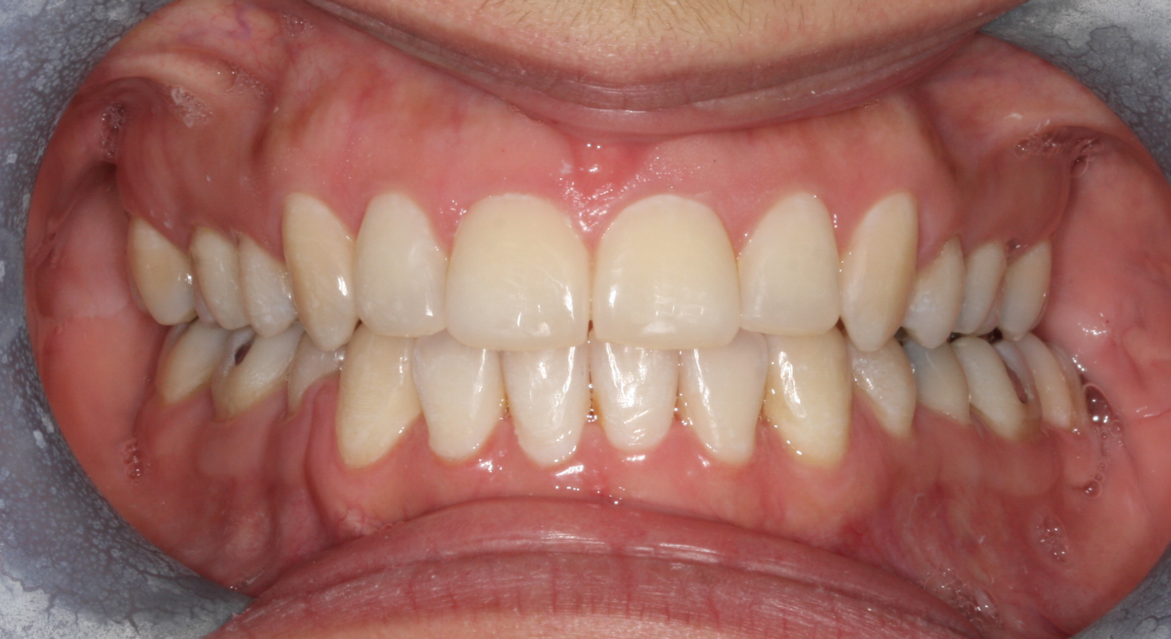 Case 3 - Front View - After