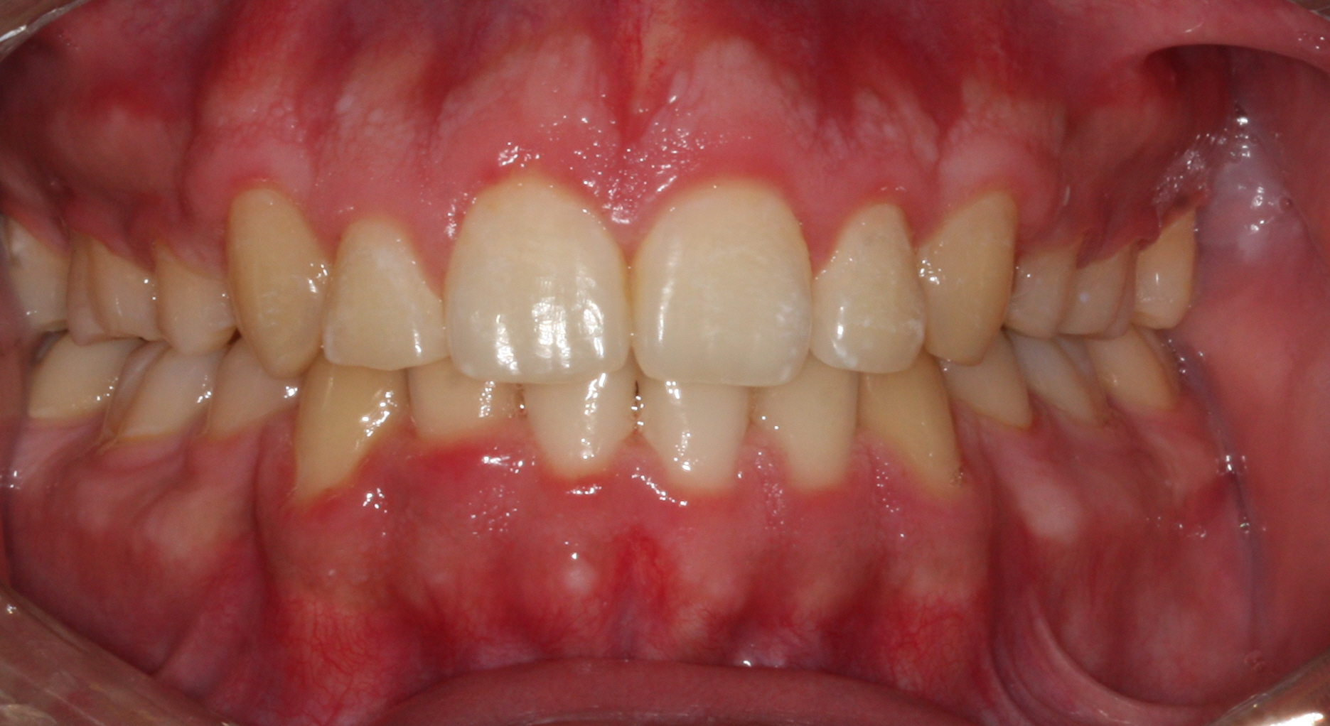 Case 2 - Front View - After