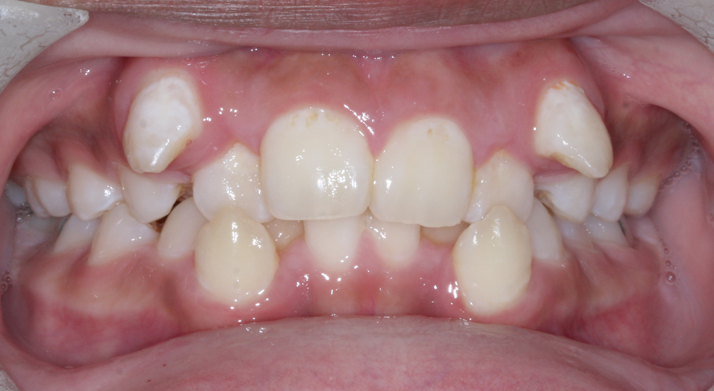 Case 1 - Front View - Before