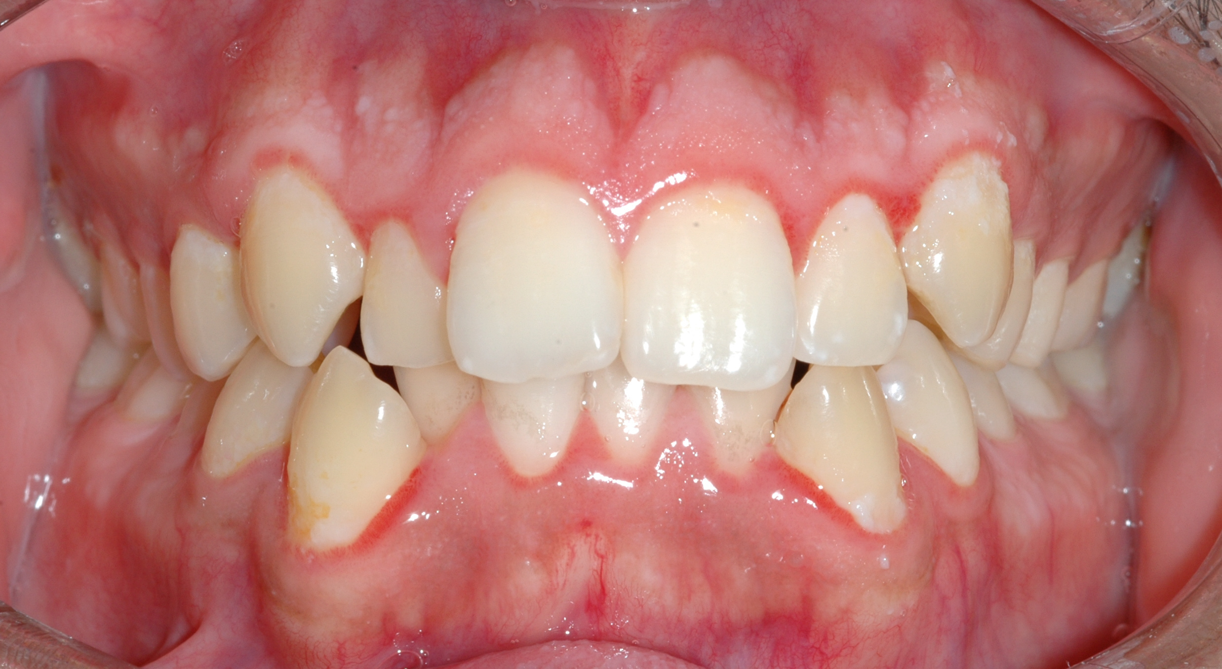 Case 2 - Front View - Before