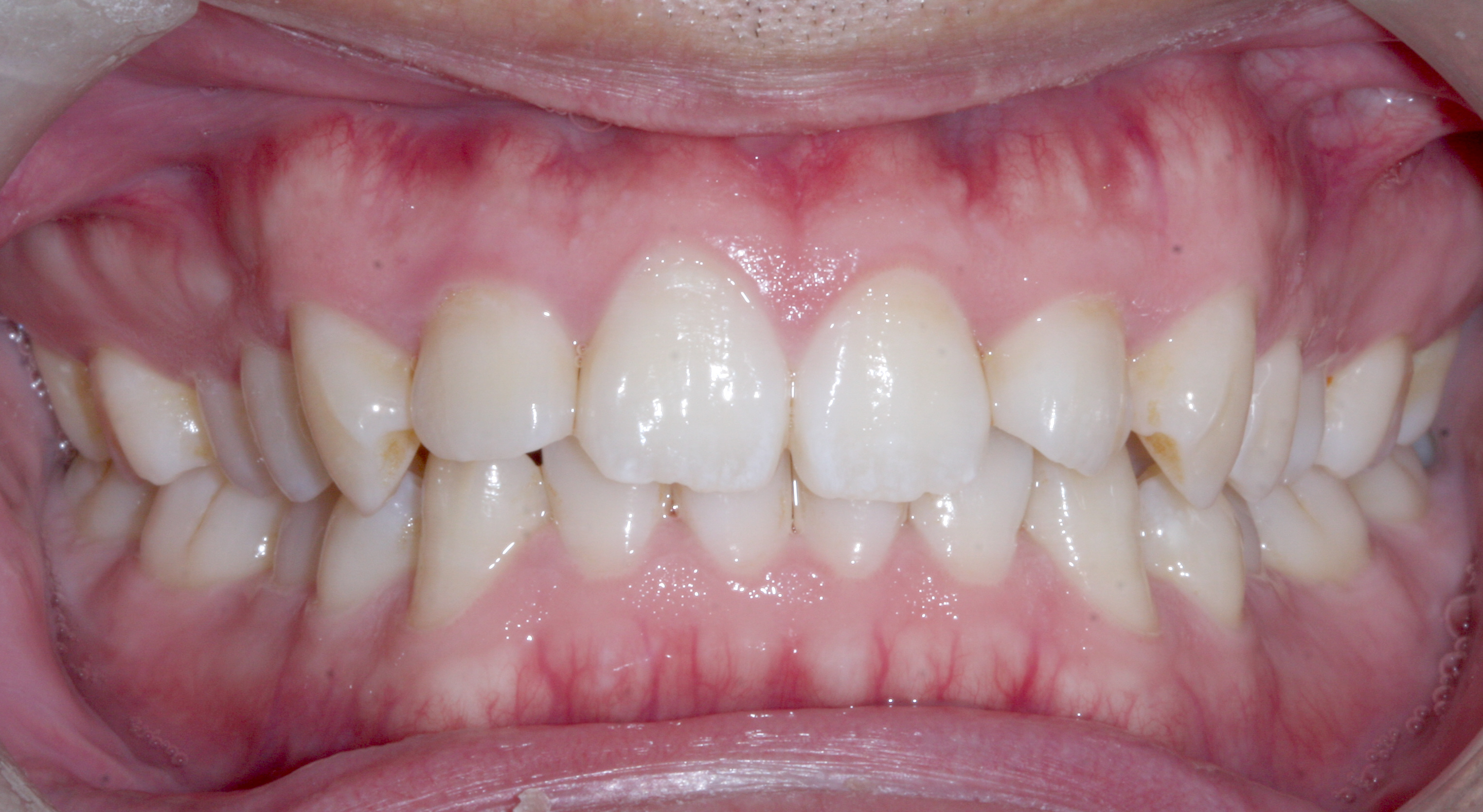 Case 4 - Front View - Before